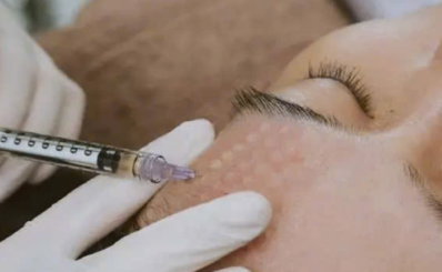 CHĂM SÓC SAU DỊCH VỤ  TIÊM MESOTHERAPY